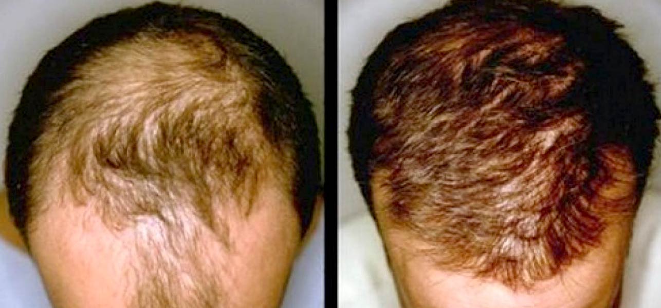 regrow hair in bald patches
